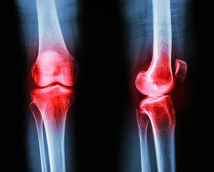 Comment soulager une douleur d'arthrose au genou?